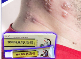 Thuốc mỡ bôi da Herpes Zona thần kinh (Hoa Trung Tiên Tây Vực)